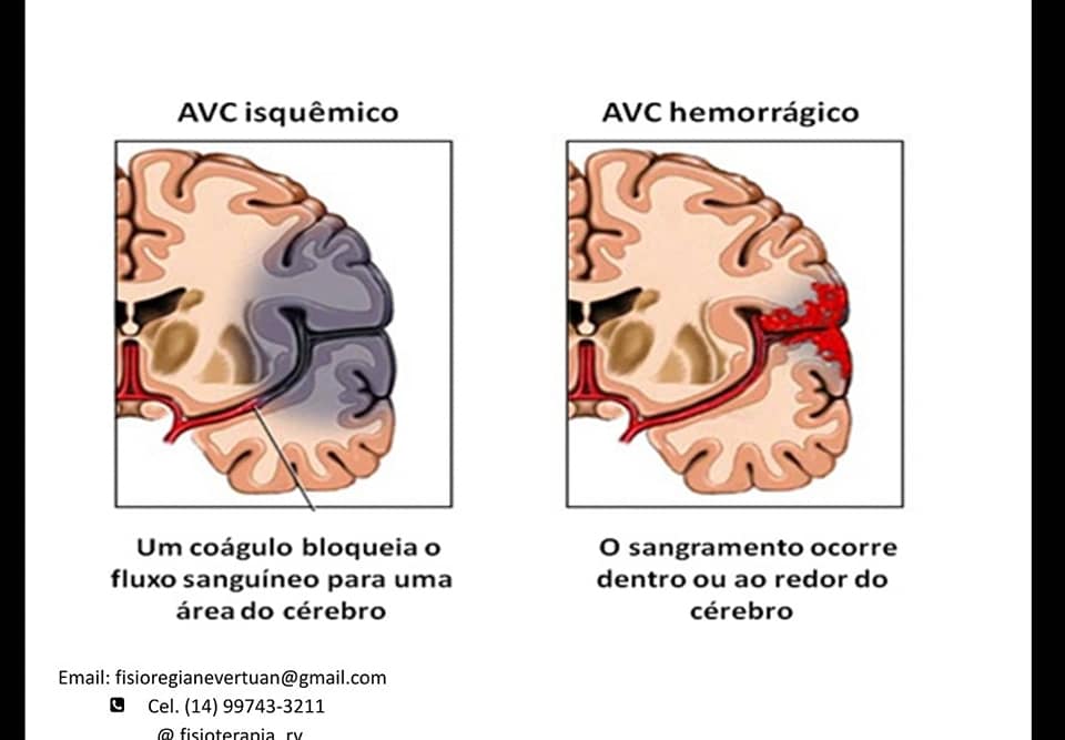 Fisioterapia_RV - O QUE É O AVC? Acidente Vascular...