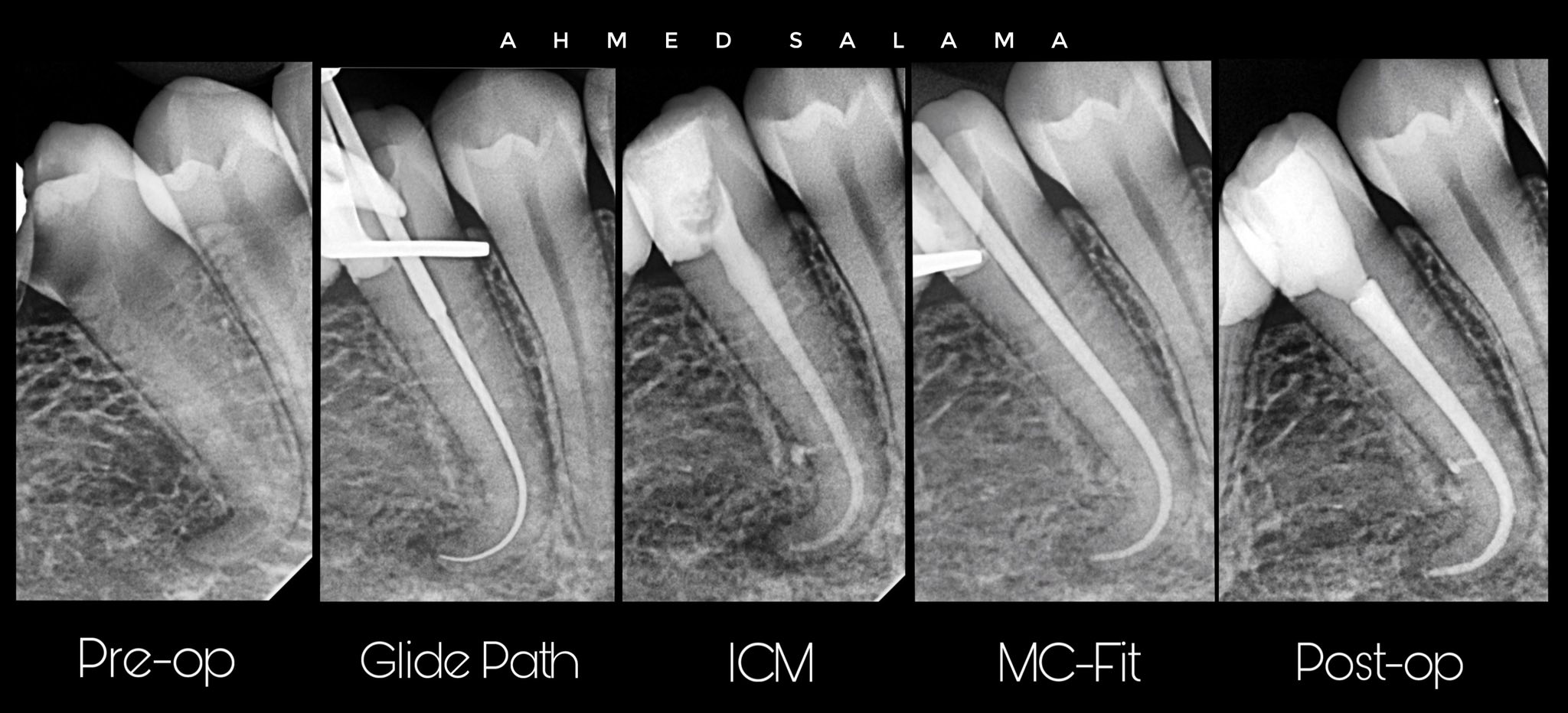 Endodontic treatment for tooth 45 with curved canal