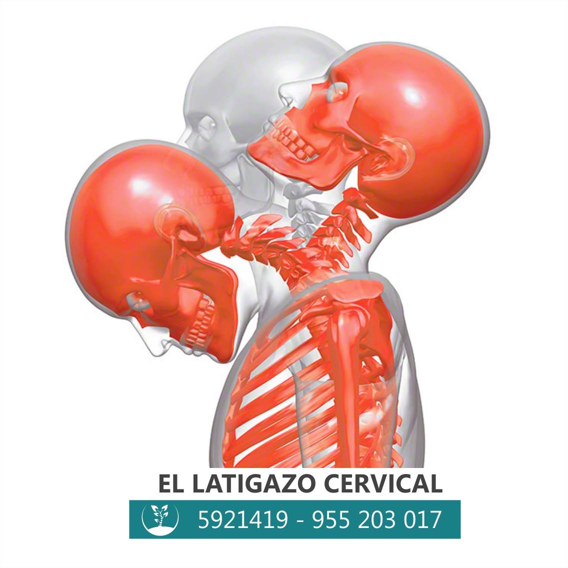El latigazo... - Centro Quiropractico Stumvoll Sede San Borja