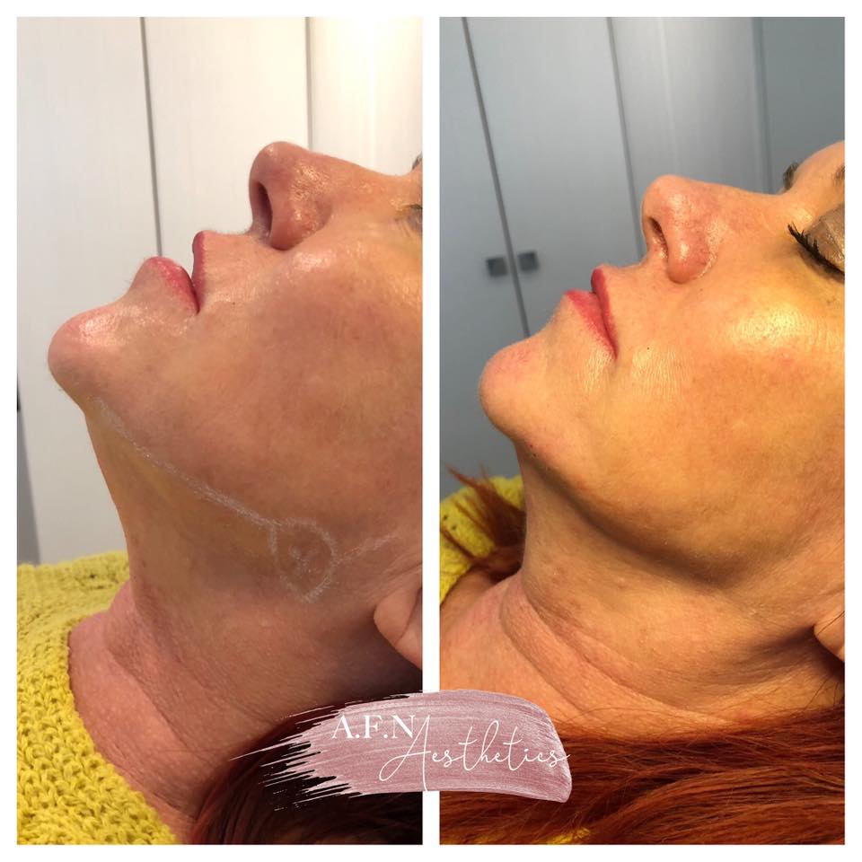 our-pain-free-cannula-technique-primrose-aesthetics