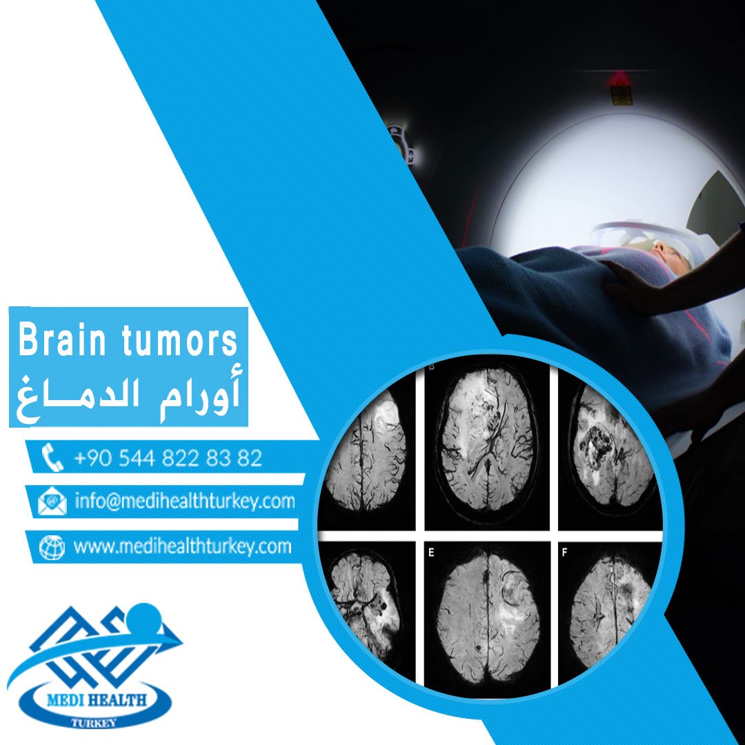 #Brain_tumor is an abnormal growth of... - Medi Health Turkey | Facebook