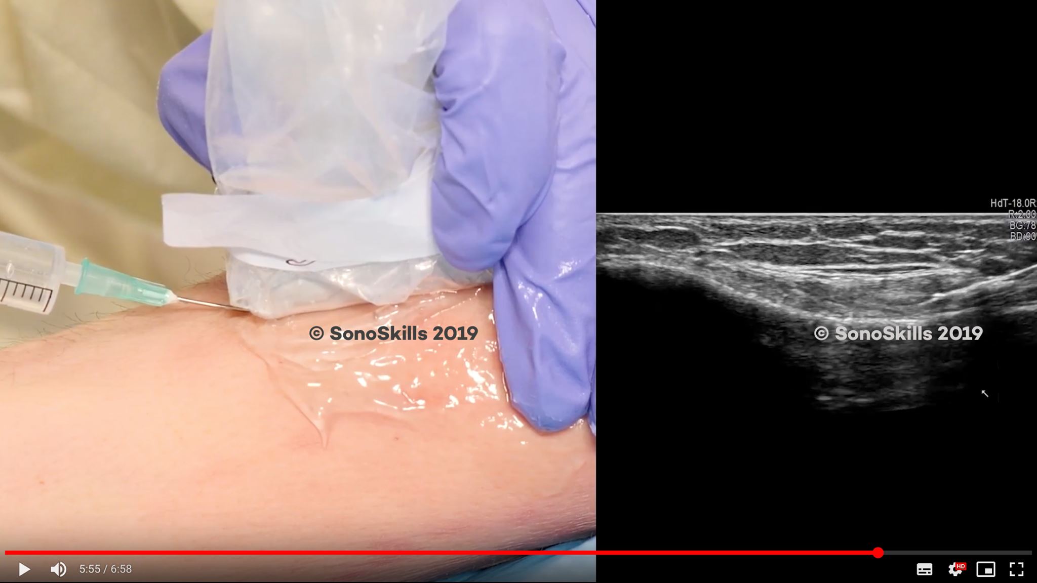 Both #ultrasound guided (USG)... - Anatomy & Physiotherapy | Facebook
