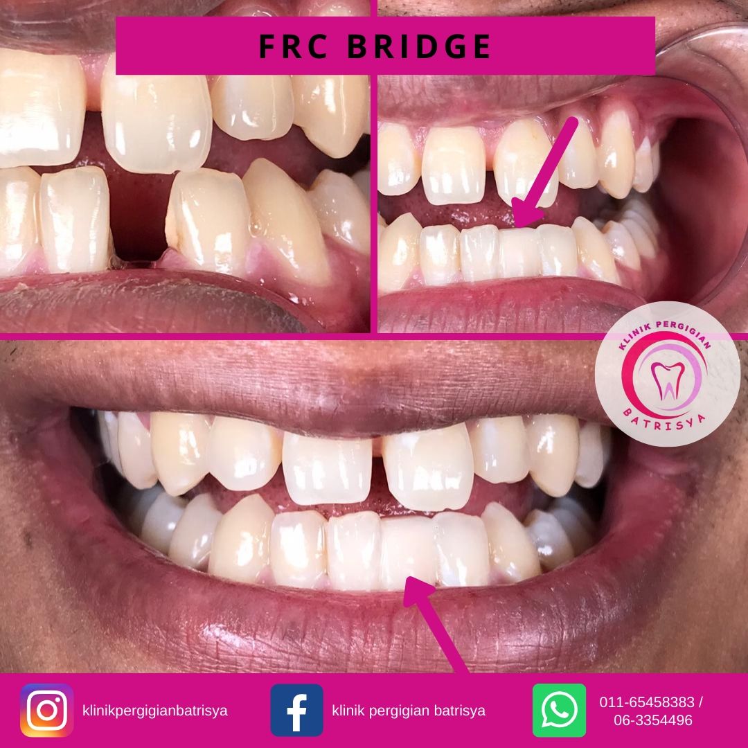 🔥🔥 FRC BRIDGE 🔥🔥 . Nak... - Klinik Pergigian Batrisya