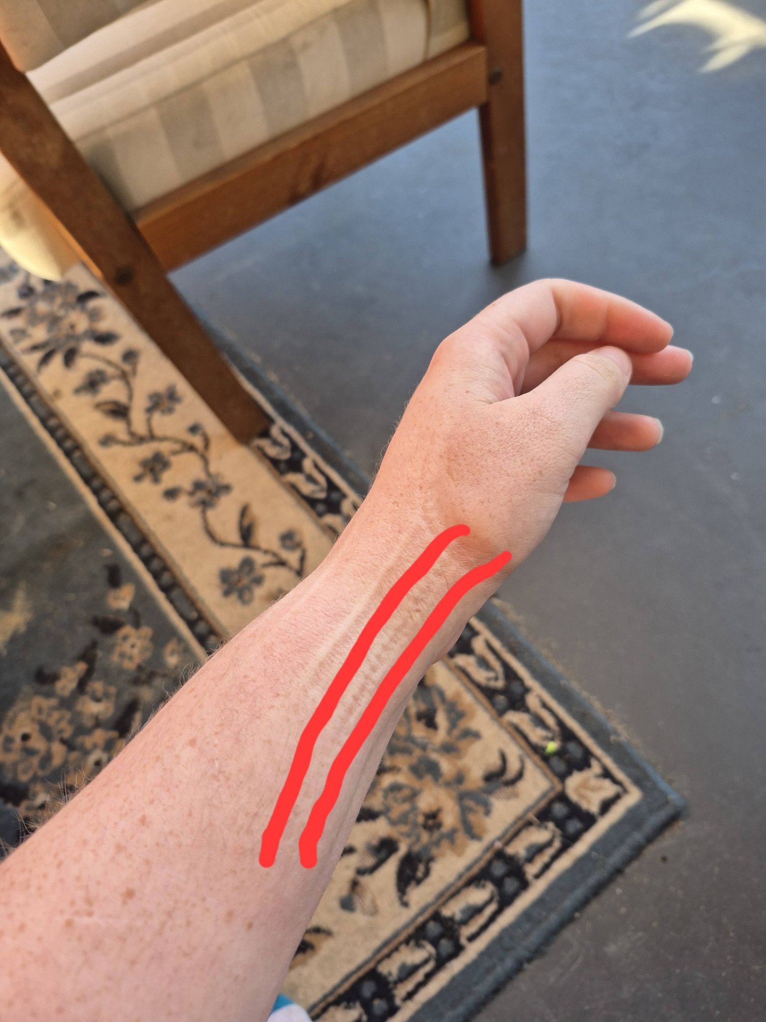 arm sore after b12 injection sore arm after vitamin b12 injection Sore arm after your vaccine? That's a good thing!-bsmoothhr Is intense whole arm pain