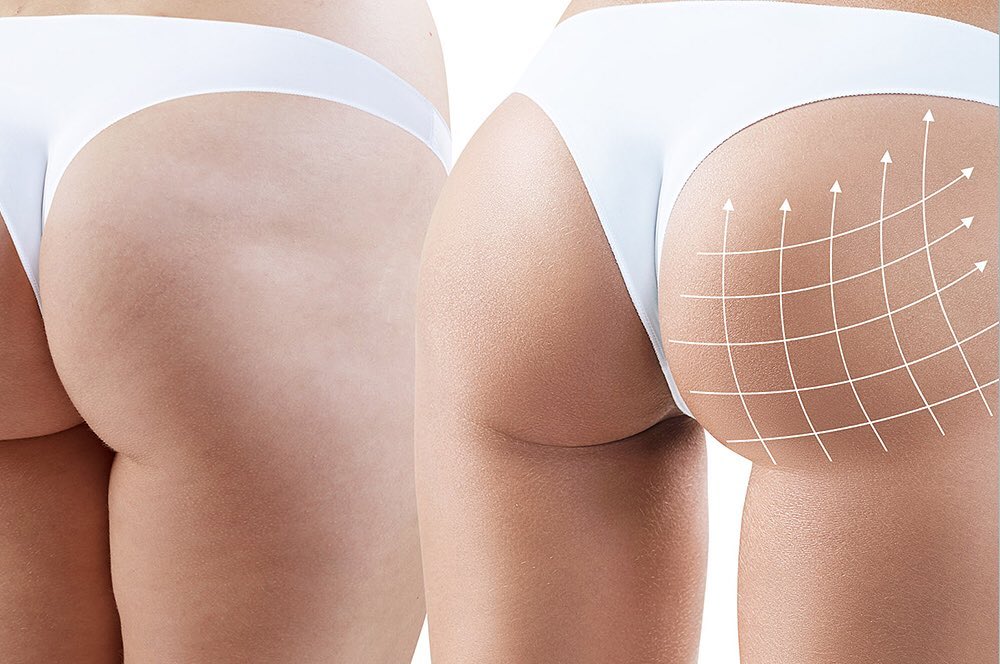 1 Paio Di Inserti In Silicone Per Glutei, Push Up Rimovibili Per Sederino - Color Carne, Comodi E Invisibili - Foto 3