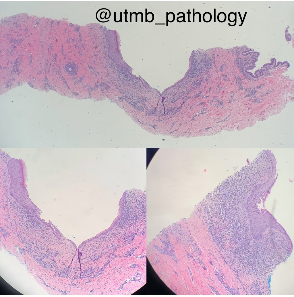 Squamous metaplasia of... - Texas Society of Pathologists