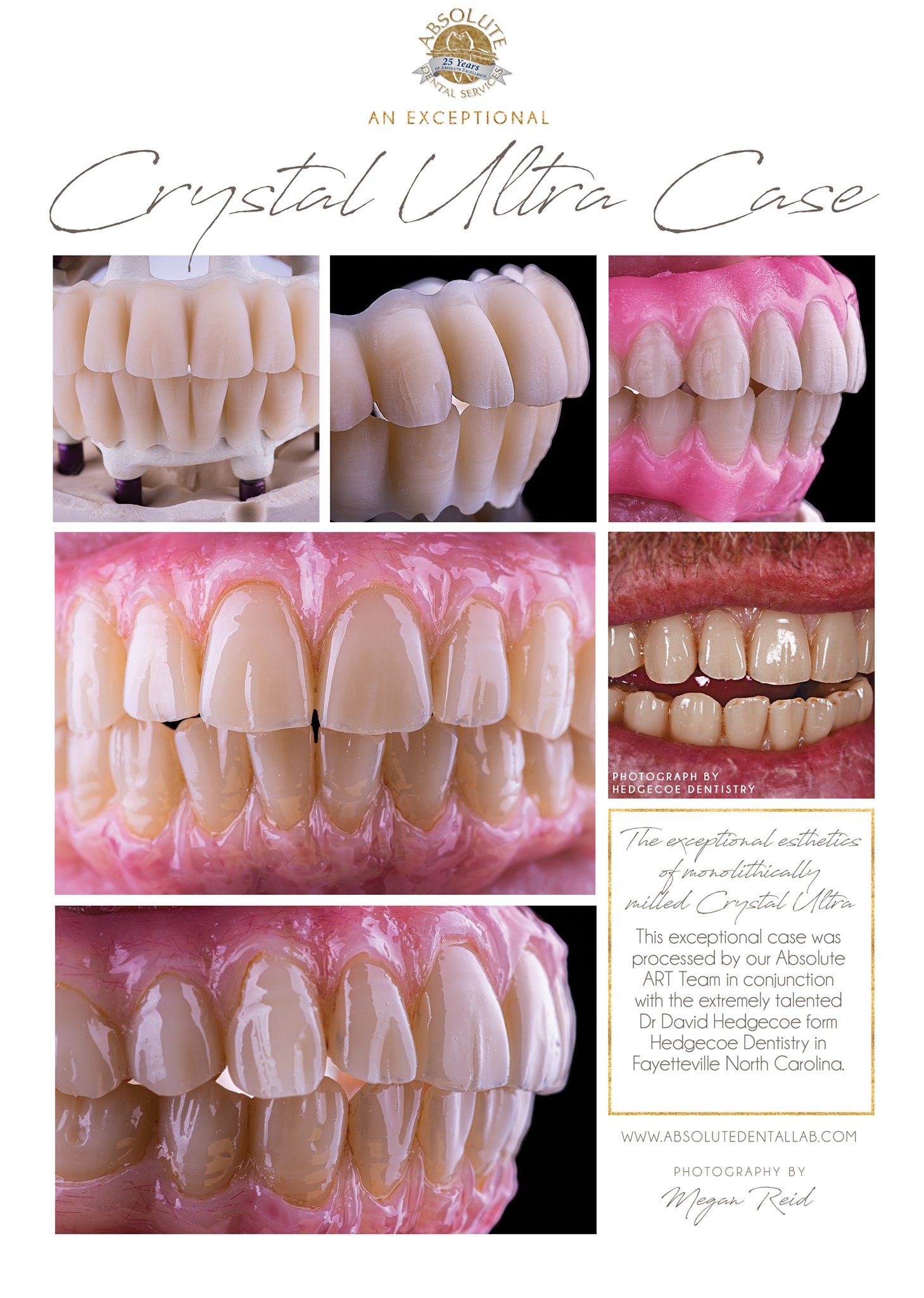 Nano-ceramics the end of broken... - Absolute Dental Services | Facebook