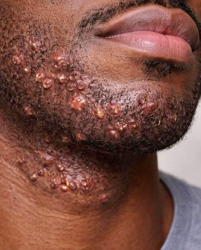glutathione razor bumps Abdul Hakeem How Nanoparticles Help in Size:90 Softgels Methyl
