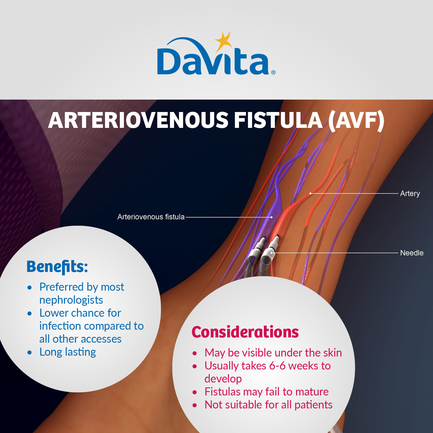 DaVita Malaysia - #DidYouKnow in arteriovenous fistula (AVF), a vein ...