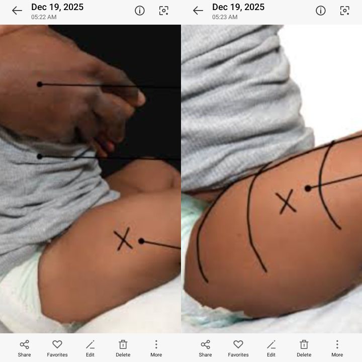 intramuscular thigh vitamin b12 injection site What is the common for in newborns? We've had a few toprev Pack Size:500ml