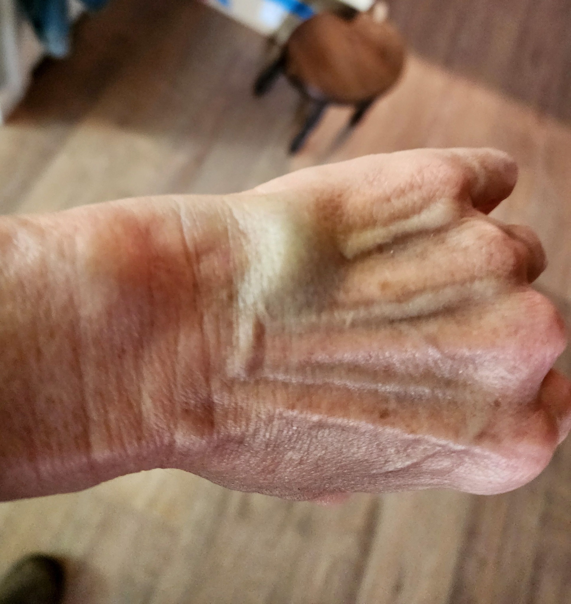 What caused a blown out spot after blood draw?