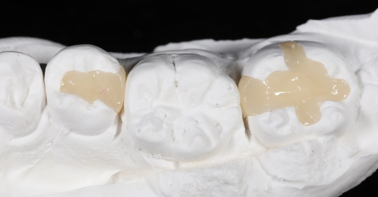 #크리스탈치과기공소 #emax #inlay #이멕스... - Crystal Dental Lab. | Facebook