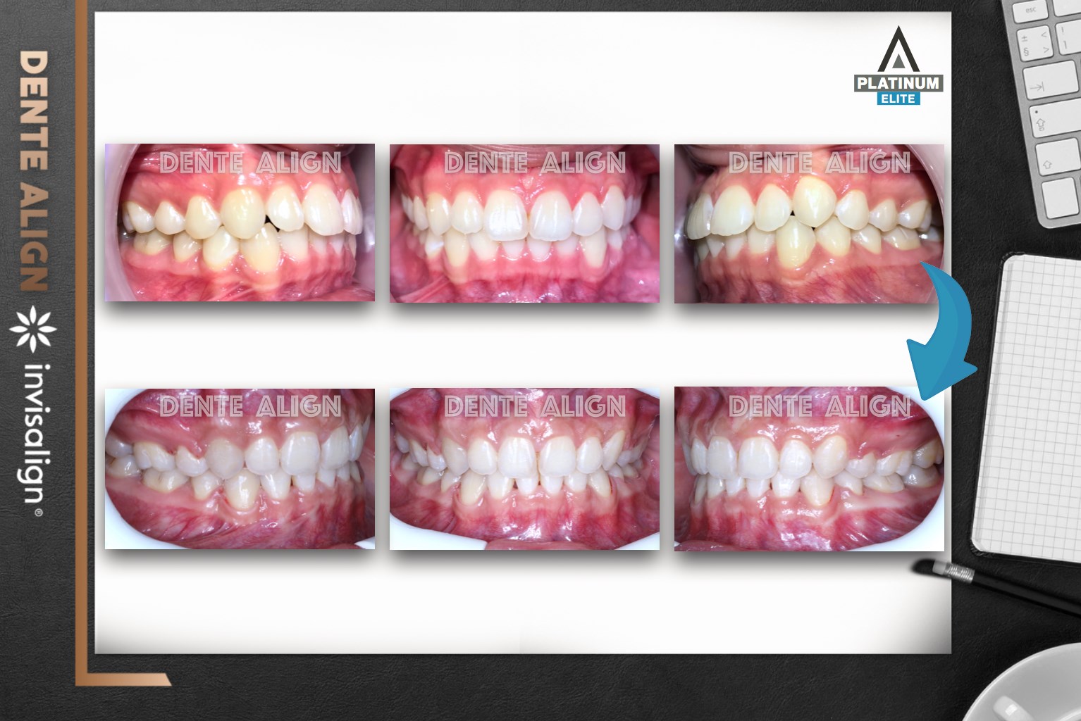 ฟันยื่น... - Dente Align Clinic - Invisalign Diamond Provider | Facebook