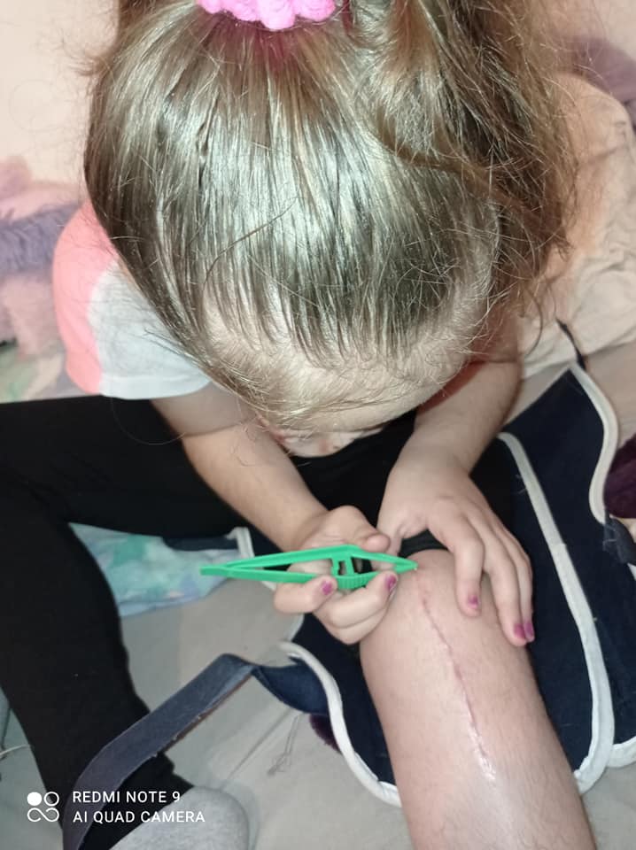 2 Enfants Ne Avec La Maladie Du Pied Bot Facebook