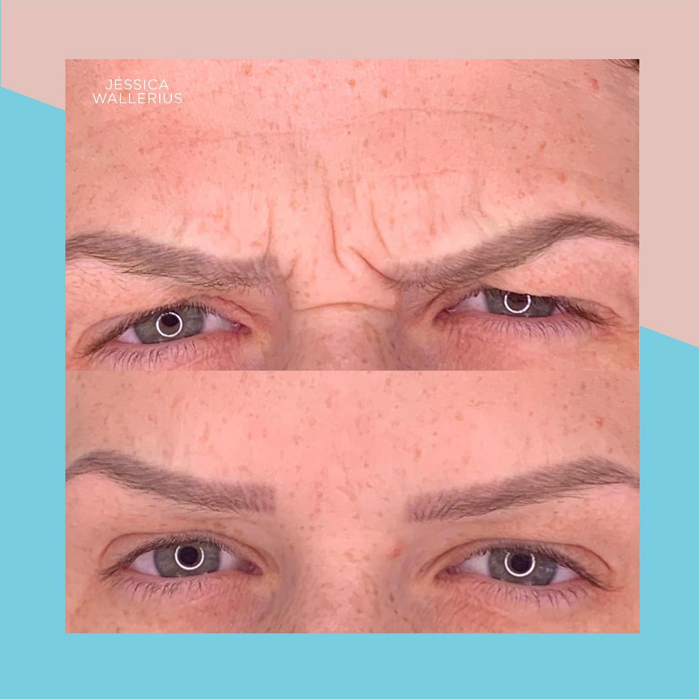 NUAN Clinic - Resultadinho lindo de Toxina Botulínica na região da ...