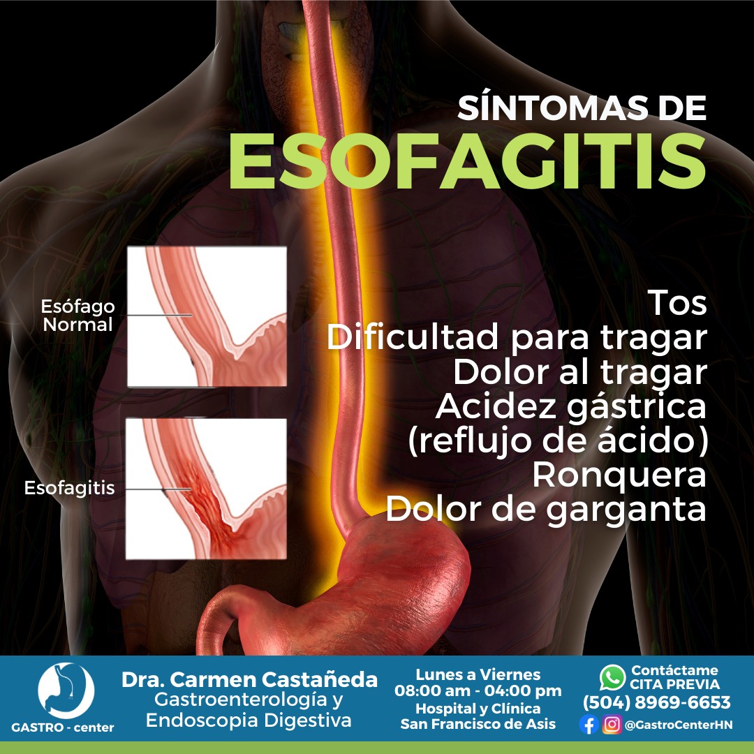 🟢La esofagitis es una inflamación... - Dra. Carmen Castañeda