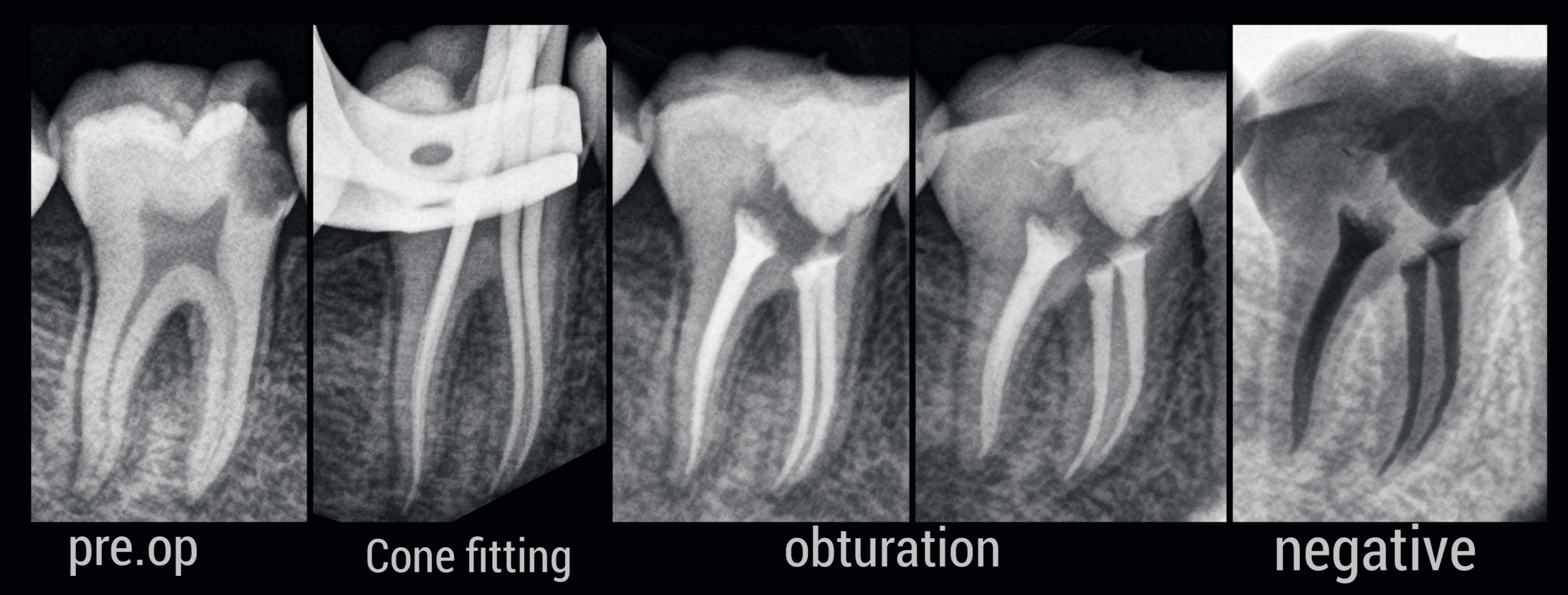 Ahmed Zakaria - Routine root canal treatment of #46 🤍... | Facebook