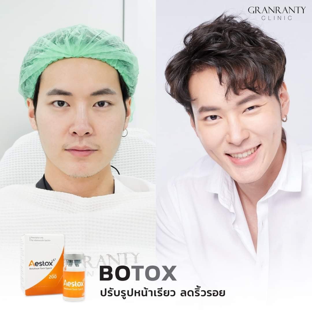 🧐 รวมรีวิว Botox ปรับรูปหน้า 📍 เห็นผลจริง หล่อเป๊ะทุกมุม กรอบหน้าชัด ลด ...