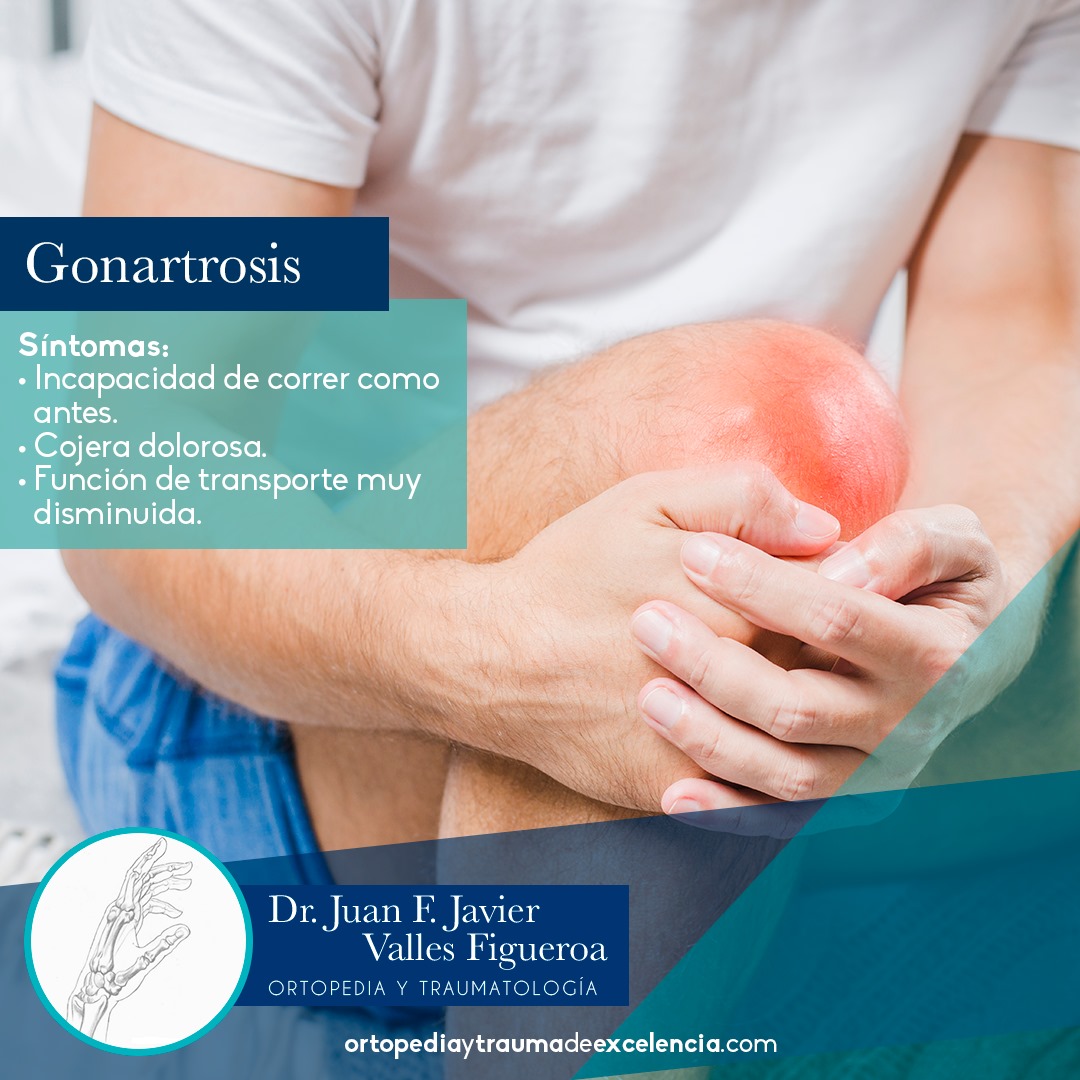 Ortopedia y Traumatología de Excelencia - La gonartrosis o artrosis de ...