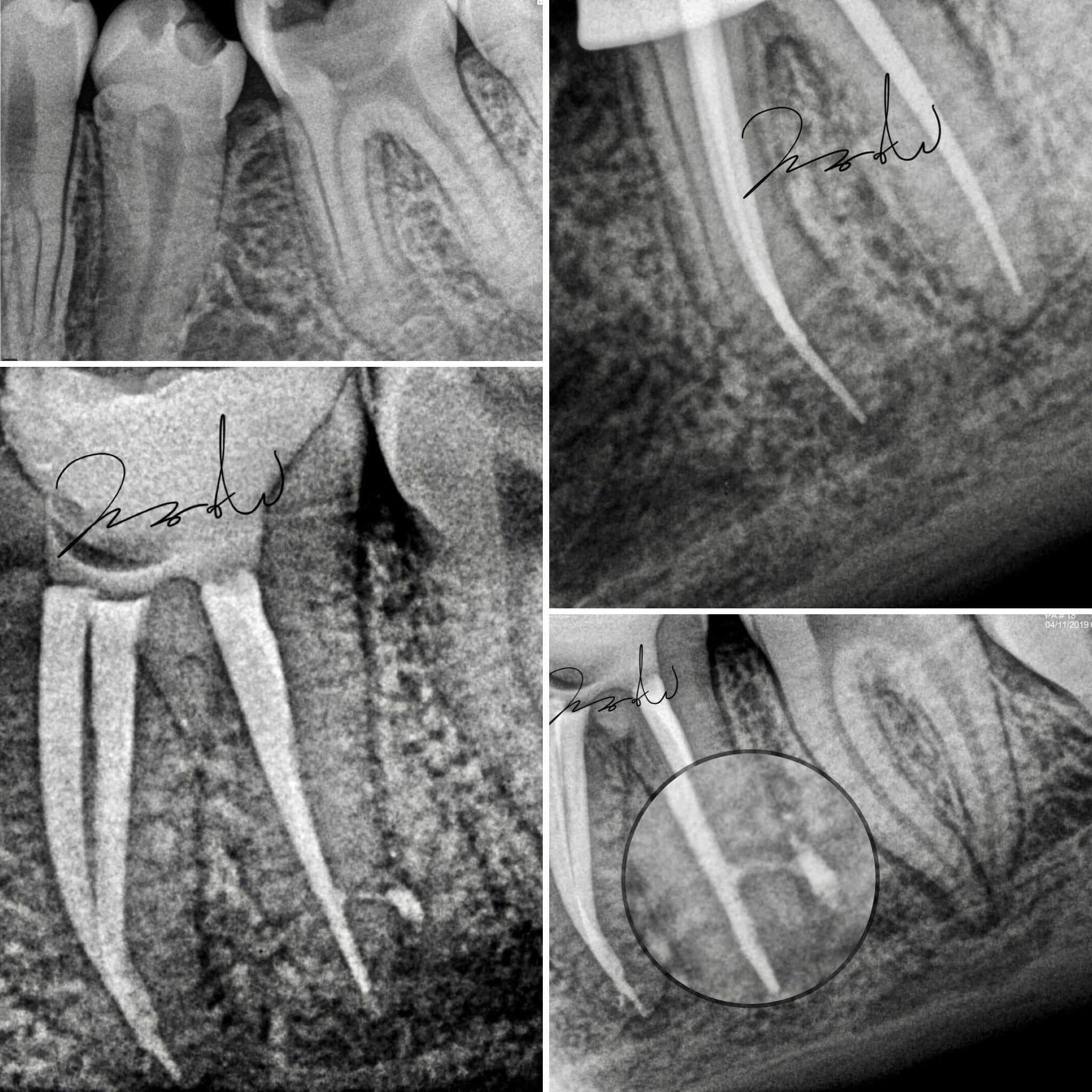 canal accessory Root canal, accessory canal and continued issues 