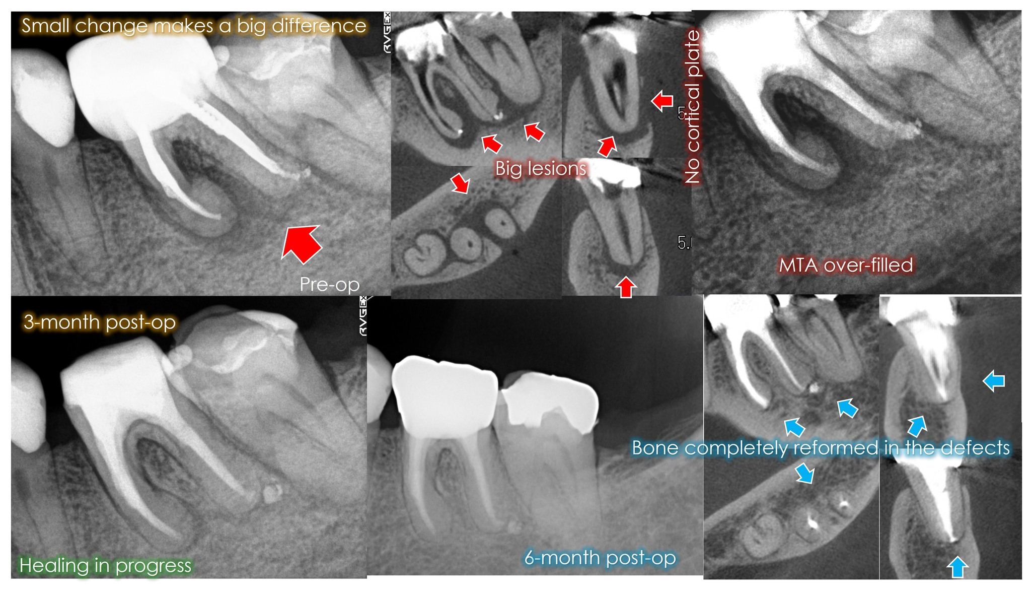Yoshi - The pre-ops of previously treared molar shows nice-looking root ...