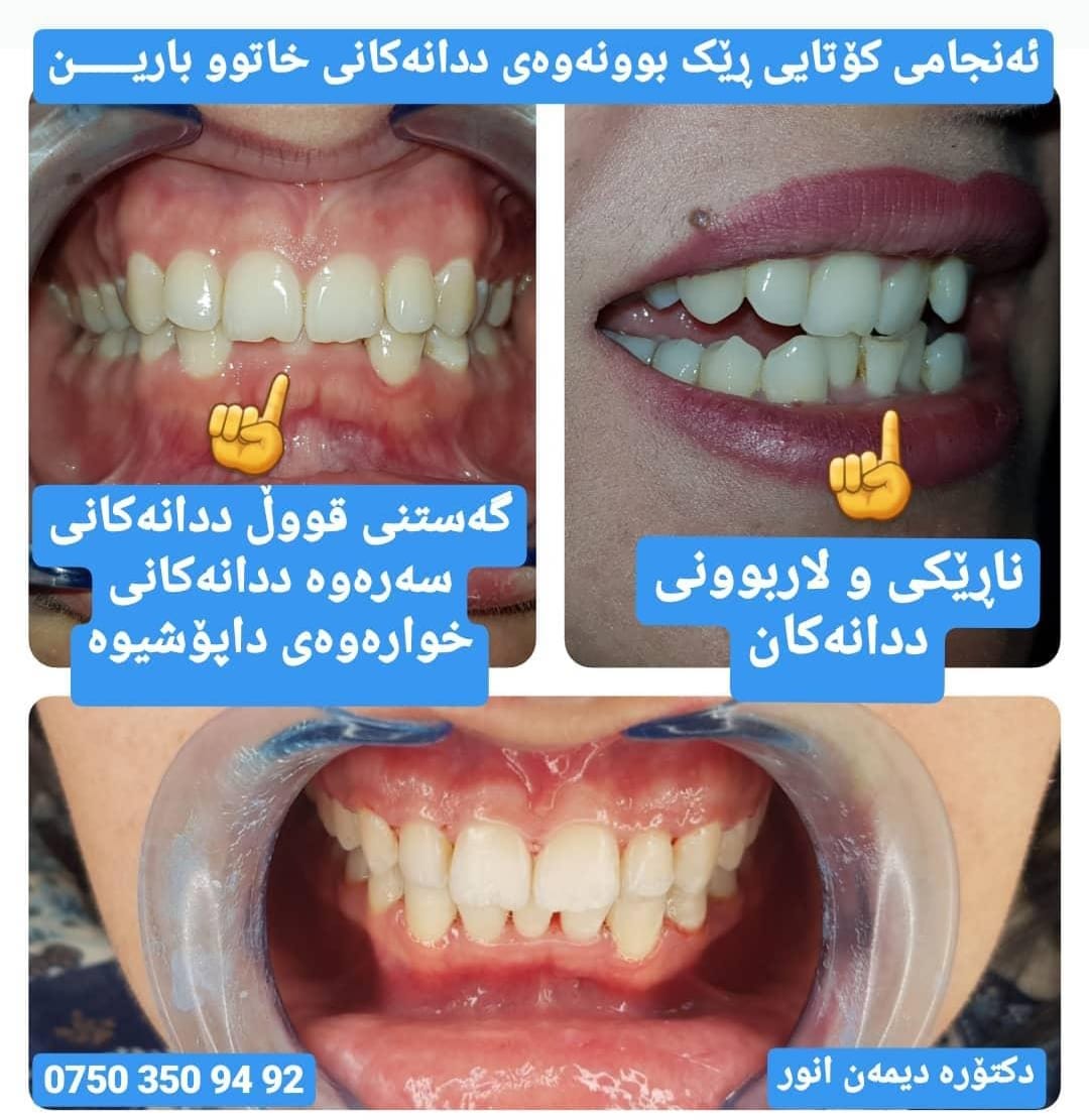 پزیشکی ددان - ئەنجامی کۆتایی ڕێک بوونەوەی ددانەکانی خاتوو... | Facebook