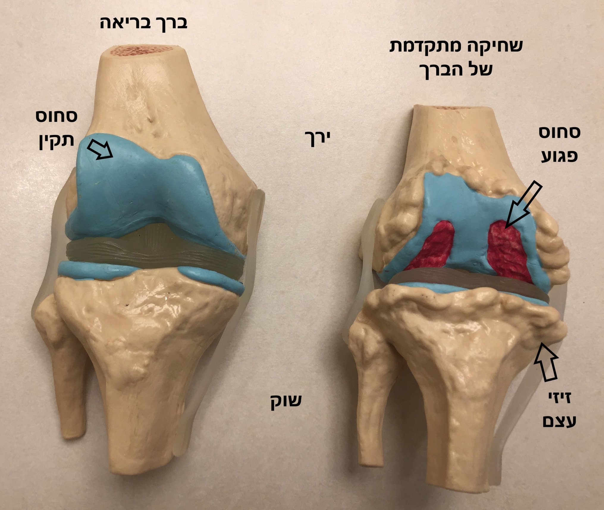 הסבר על שחיקה של הברך וניתוח החלפת ברך מטרת ניתוח החלפת הברך היא לשפר ...