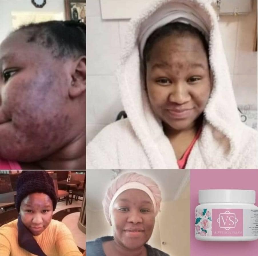 glutathione skin lightening in benoni Velvet Care Products👌 Customer Care ￼⁨063 053 4862⁩ Shop Online www.khitawear.co.za ,City Medical Wholesalers Pretoria, Lakefield Pharmacy Benoni,Ollesdas Pharmacy Bonaero shopping Centre Kempton Park,Palm Springs Springs, Botswana 75 612 316 Glutathione 60 capsules best price Swanson Vitamins Antioxidant Support Volume:600mg – 10 vial lab pack (Save 10%)