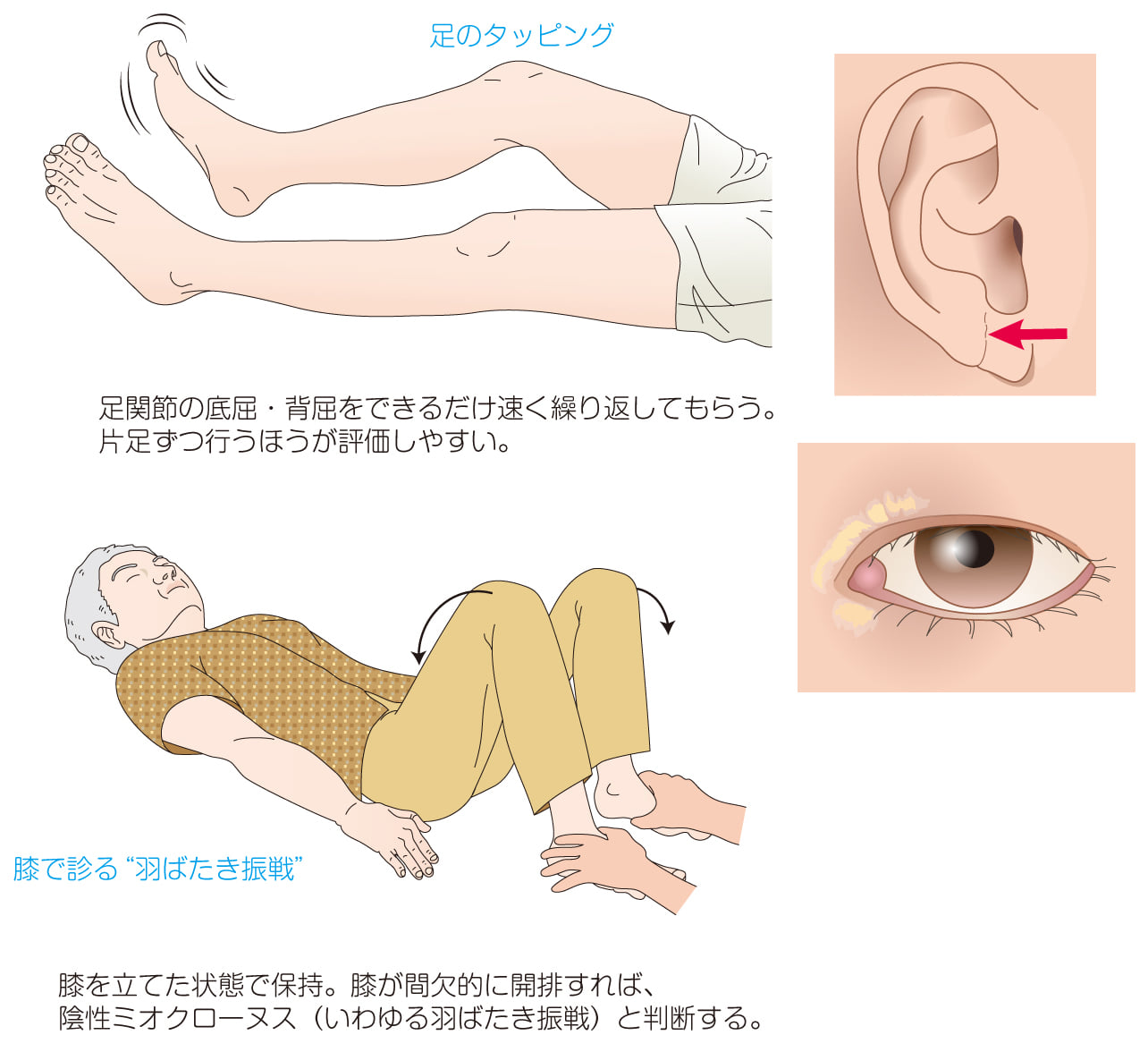 羽ばたき 振 戦