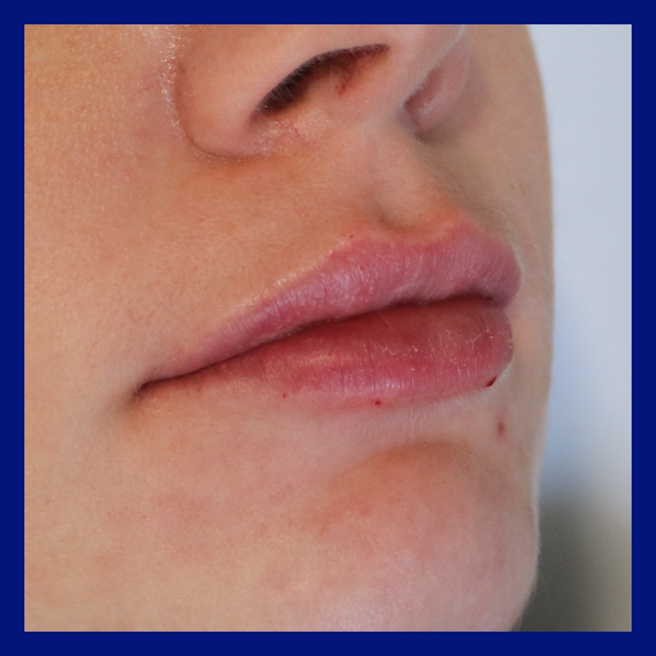 Dr - Injection 💉 de 1ml de #restylanelyps pour repulper de jolies lèvre ...