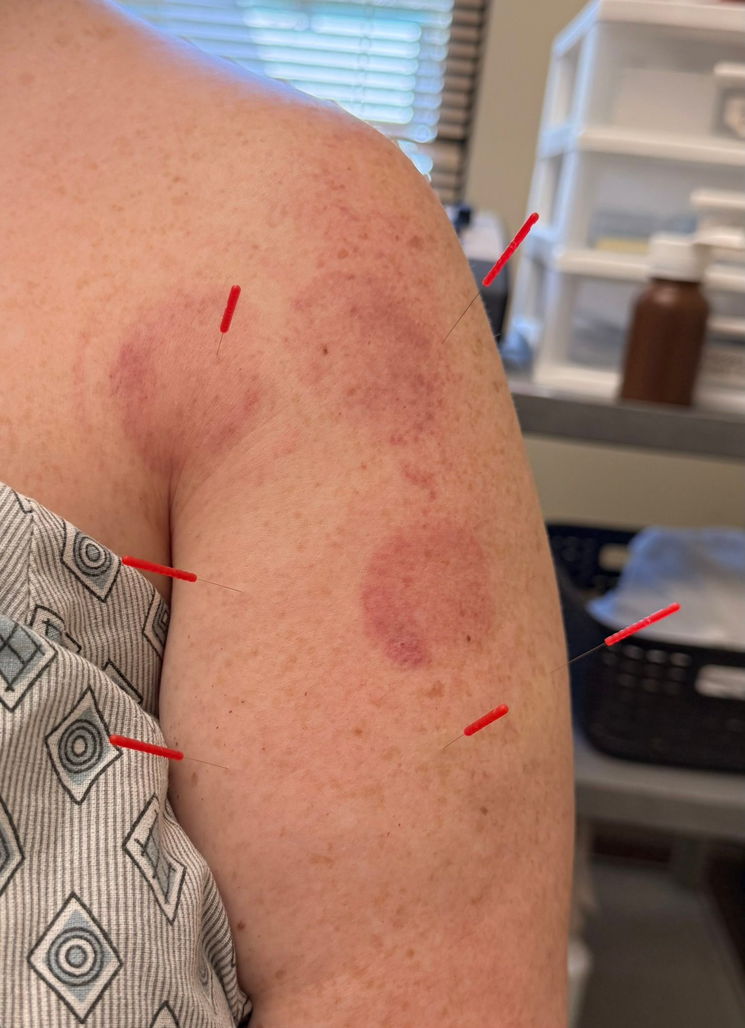bpc 157 for slap tear (Body Protection Compound-157)  Limitless Wellness Lab BPC-157 in Miami: Cost, Legality