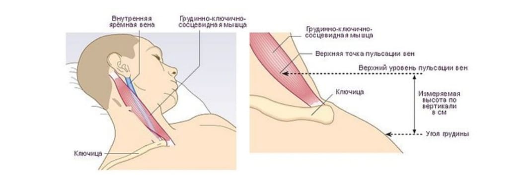 Флеботонометр на латинском. Правая внутренняя яремная Вена. Внутренняя яремная Вена клапаны. Правая наружная яремная Вена. Внутренняя и наружная яремные вены