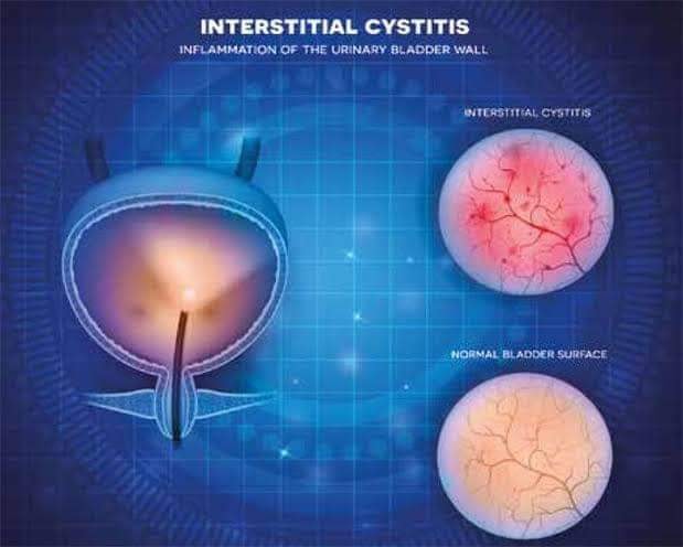 Effect of BPC-157 on Symptoms in Patients with Interstitial Cystitis: A Pilot Study [Edwin Lee](https://pubmed.ncbi.nlm.nih.gov/?term=Lee+E&cauthor_id=39325560), [Christopher Walker](https://pubmed.ncbi.nlm.nih.gov/?term=Walker+C&cauthor_id=39325560 