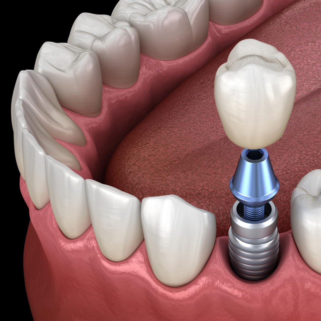 Fayetteville-Manlius Oral Surgery - Dental implants are small titanium ...