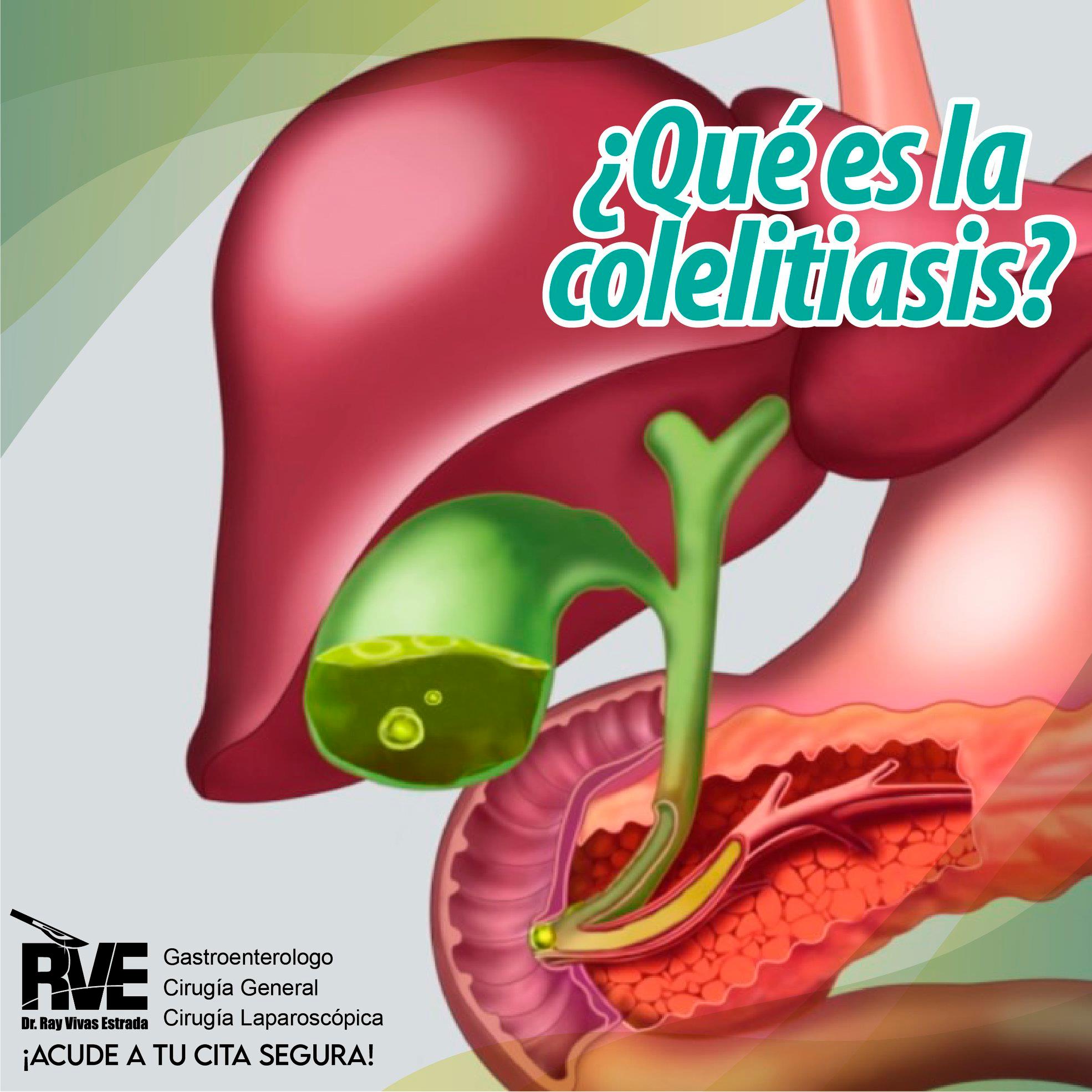 La colelitiasis... - Gastroenterólogo. Dr Ray Vivas Estrada