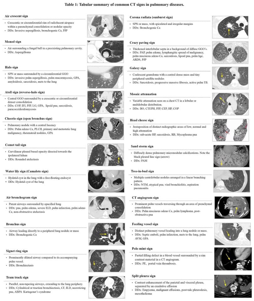 Tabular Summary of Common CT Signs on Pulmonary Imaging ⬇️