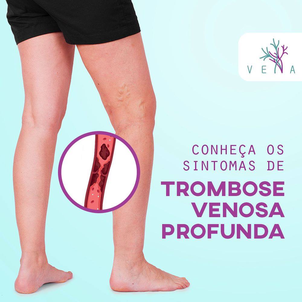 Sintomas De Trombose Venosa Invasc Instituto Vascular | A Trombose