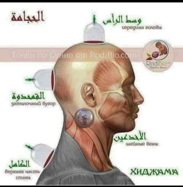 سنيزي الفترة المحيطة بالجراحة التدقيق الحجامة في اليافوخ Living Q Com