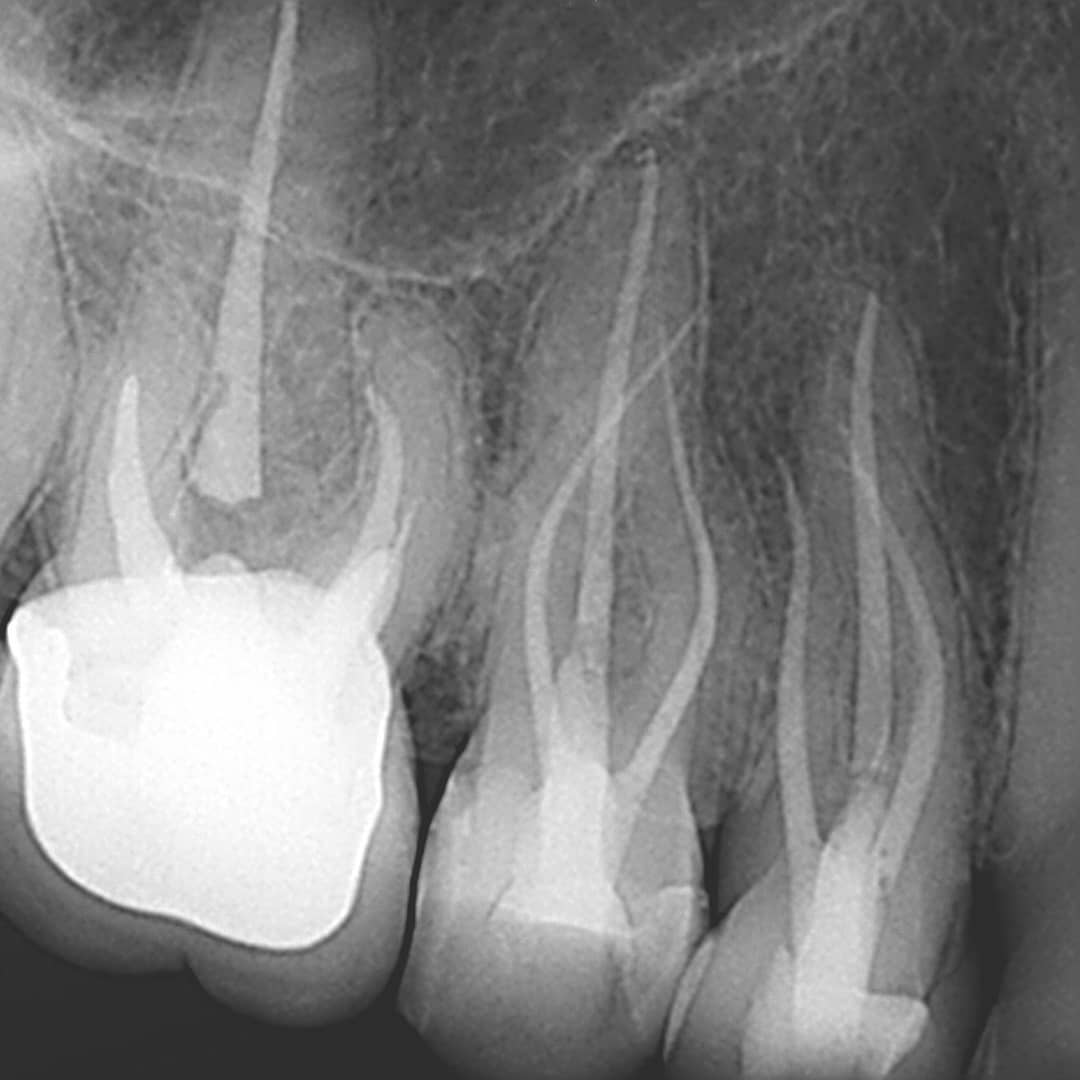 Thames Valley Endodontics - Luis DaSilva DDS, MSc Endo, FRCDC - 1.5 RCT ...