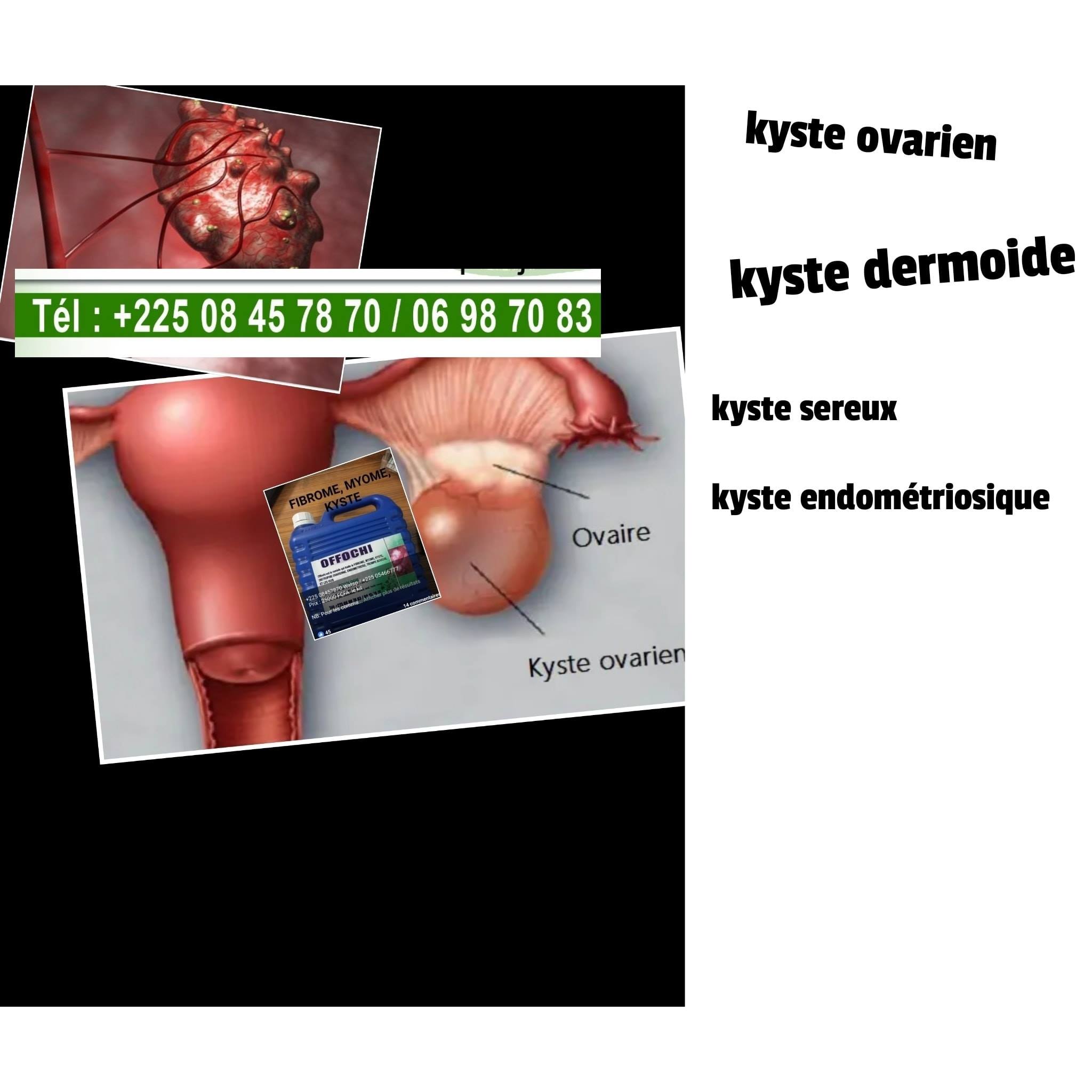 Qui Veut Guerir De Kyste Rapidement Gbochi Fertilite Bio Facebook