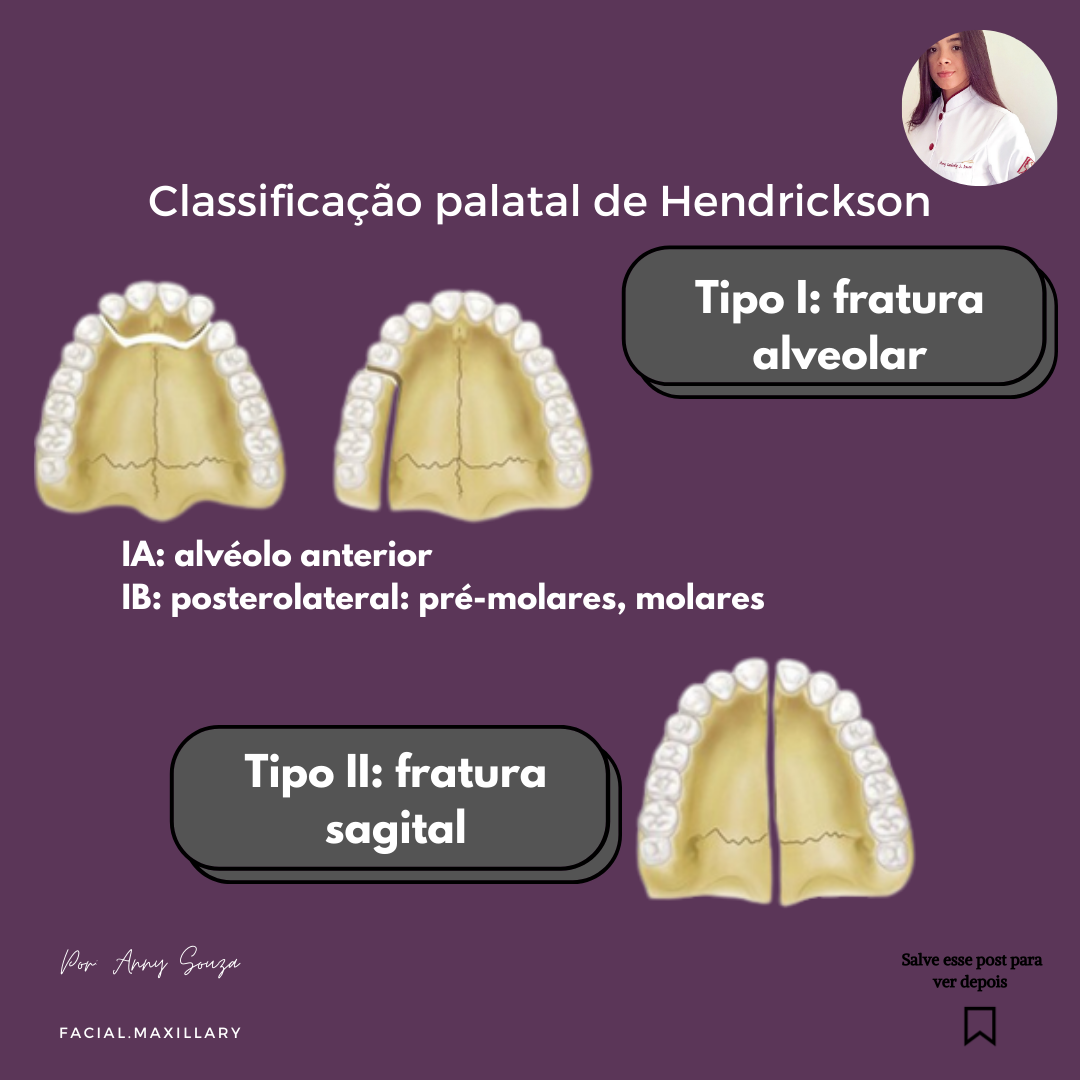 Você sabe quais sãos as fraturas de... - facial.maxillary | Facebook
