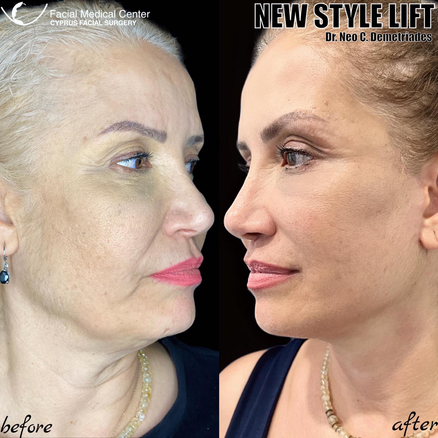 The Ultimate transformation…The... - Cyprus Facial Surgery