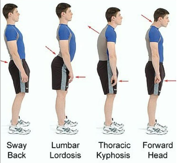 My - Can you recognise your posture in one of these? Poor posture and ...