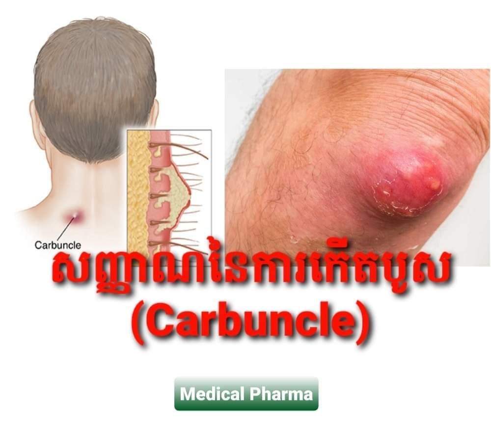 Dr - #សញ្ញាណនៃការកើតបូស #Carbuncle Carbuncle (បូស ...