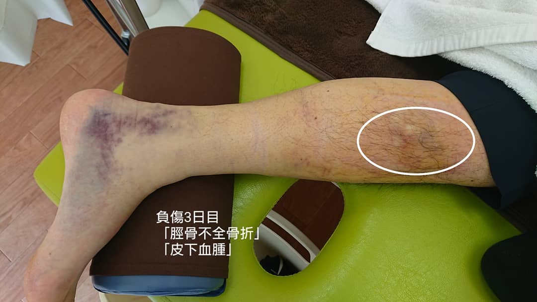 接骨院えん 脛骨不全骨折と皮下血腫 皮下血腫の症状がひどかった症例です サッカーで患部を思いきり蹴られて負傷 فيسبوك