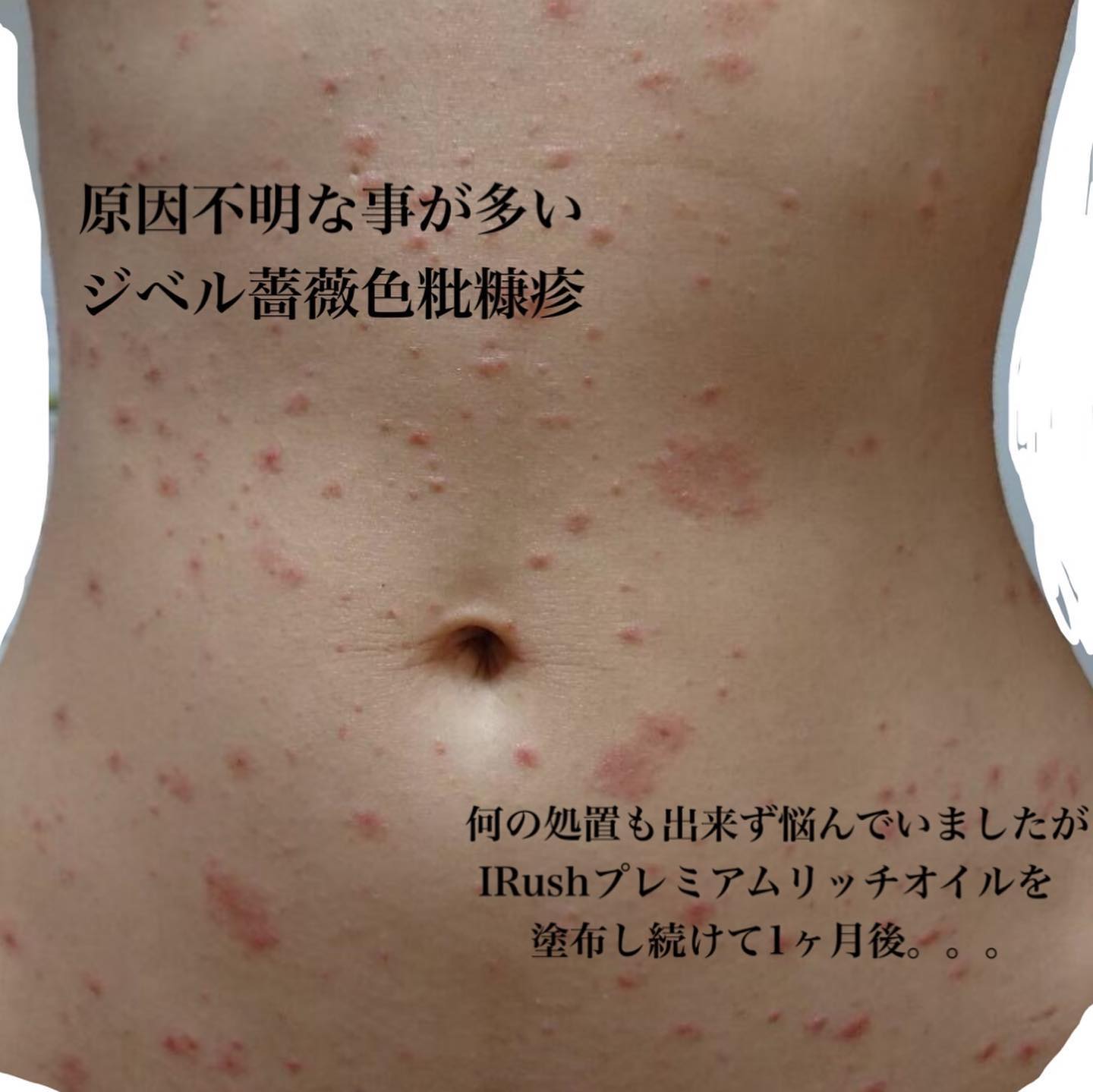 ジベル 薔薇色 粃 糠 疹 ストレス