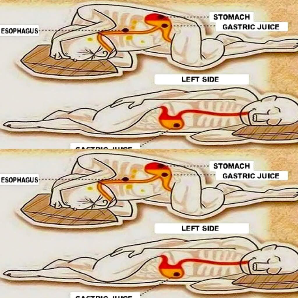Best Sleeping Position for Acid Reflux and Heartburn | Facebook
