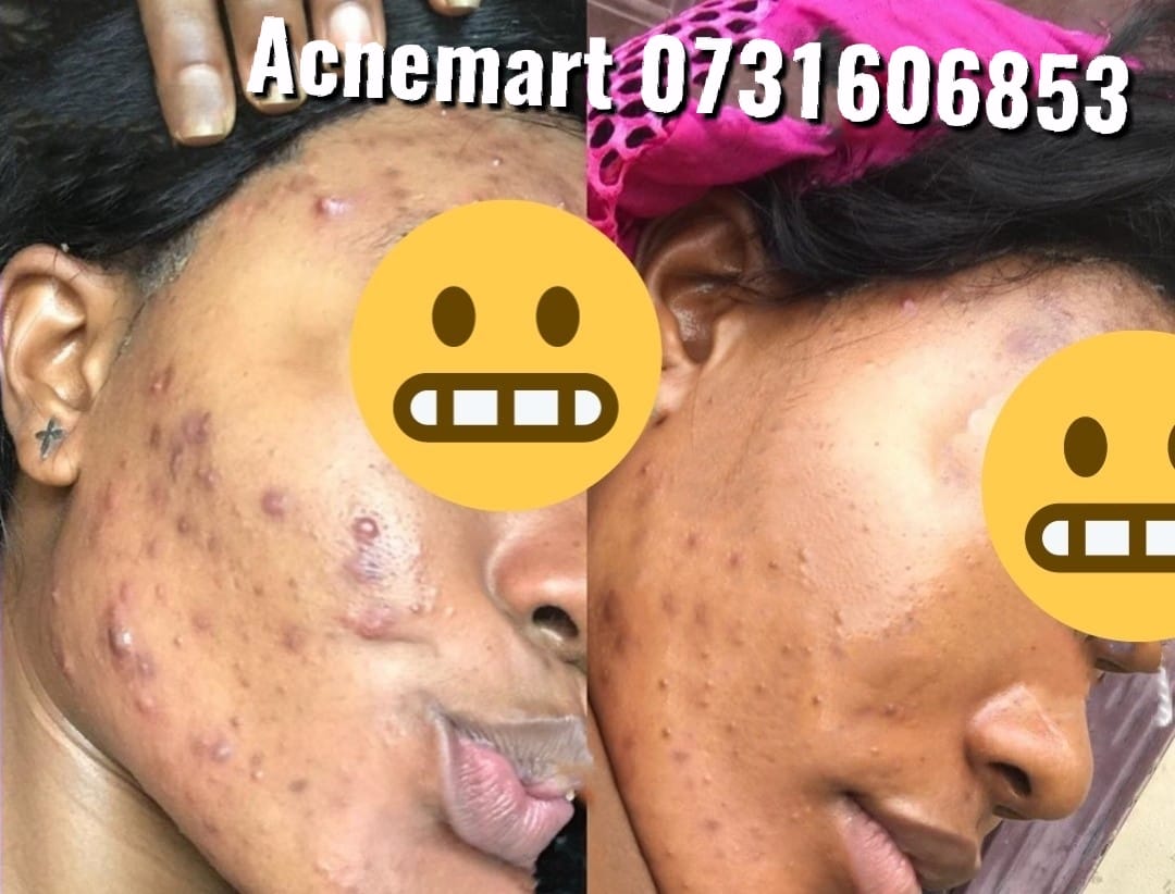 Acnemart - When before meets after check today's post on...