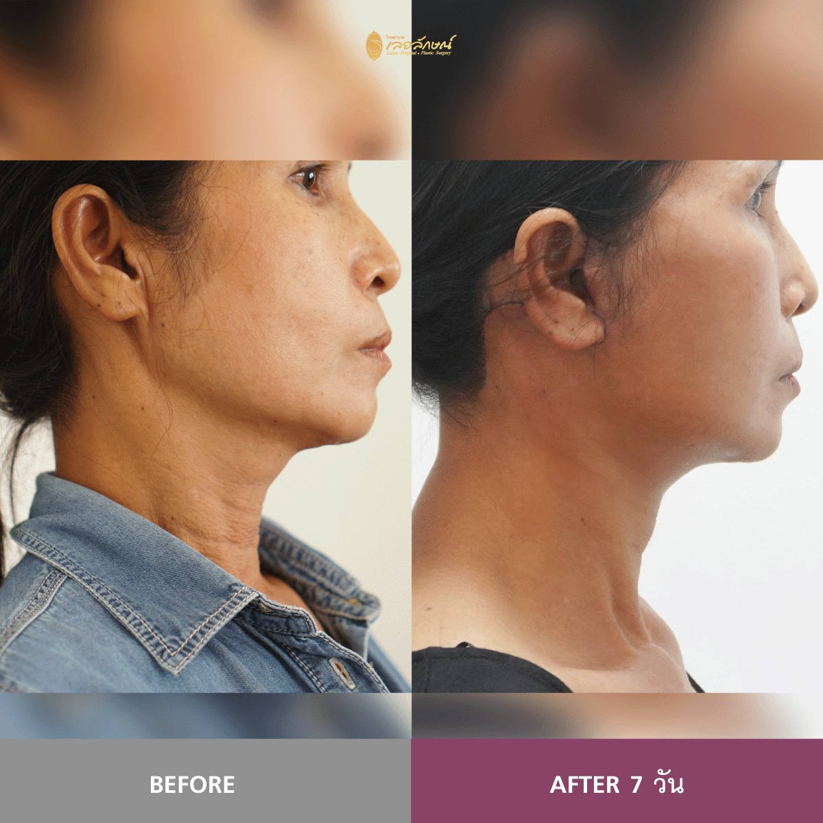 เปลี่ยนแป... - ดึงหน้า FaceLift AgeLock ยกคิ้ว Lelux Hospital | Facebook