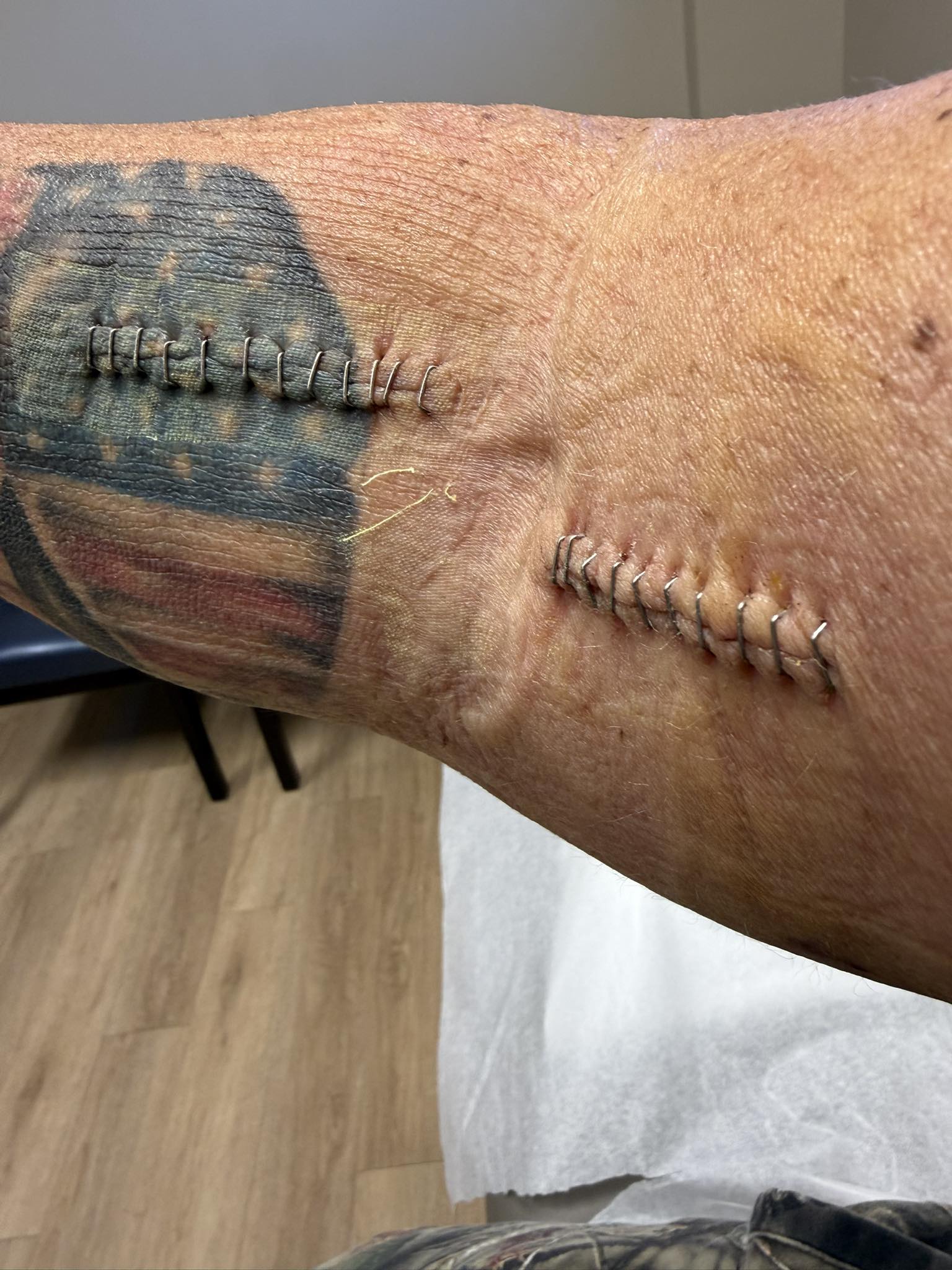 bpc 157 bicep tear Cast came off today, staples come out next week! = No bueno! B12 Deficiency Shop B12 Syringes and Quantity:2-Pack